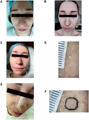 Case report: Multiple facial trichoepitheliomas caused by p.Val835SerfsTer52 variant of CYLD gene